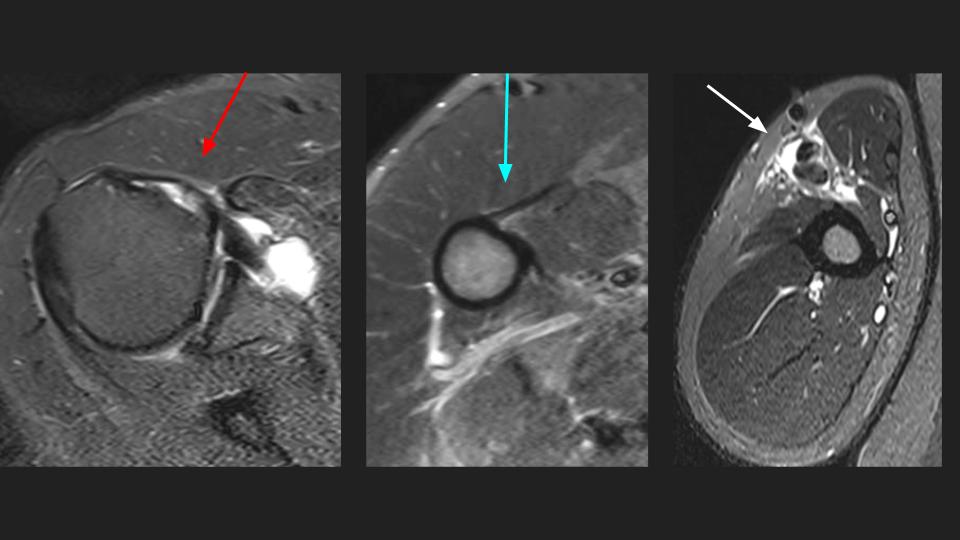 Figure 3 for case tendon of long head of biceps brachii ( RID1944 )